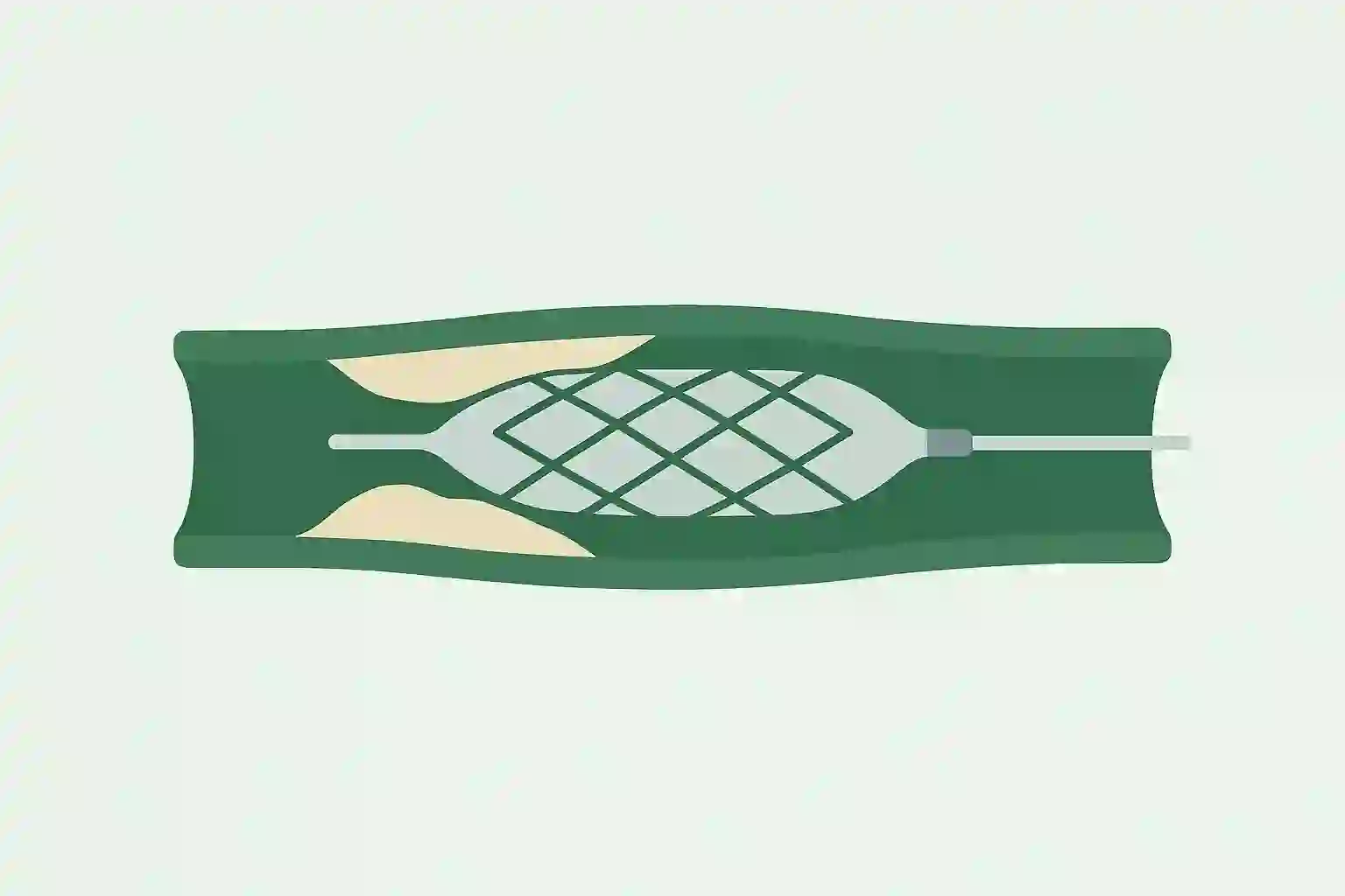Angioplasty (PTCA) - Cardiology