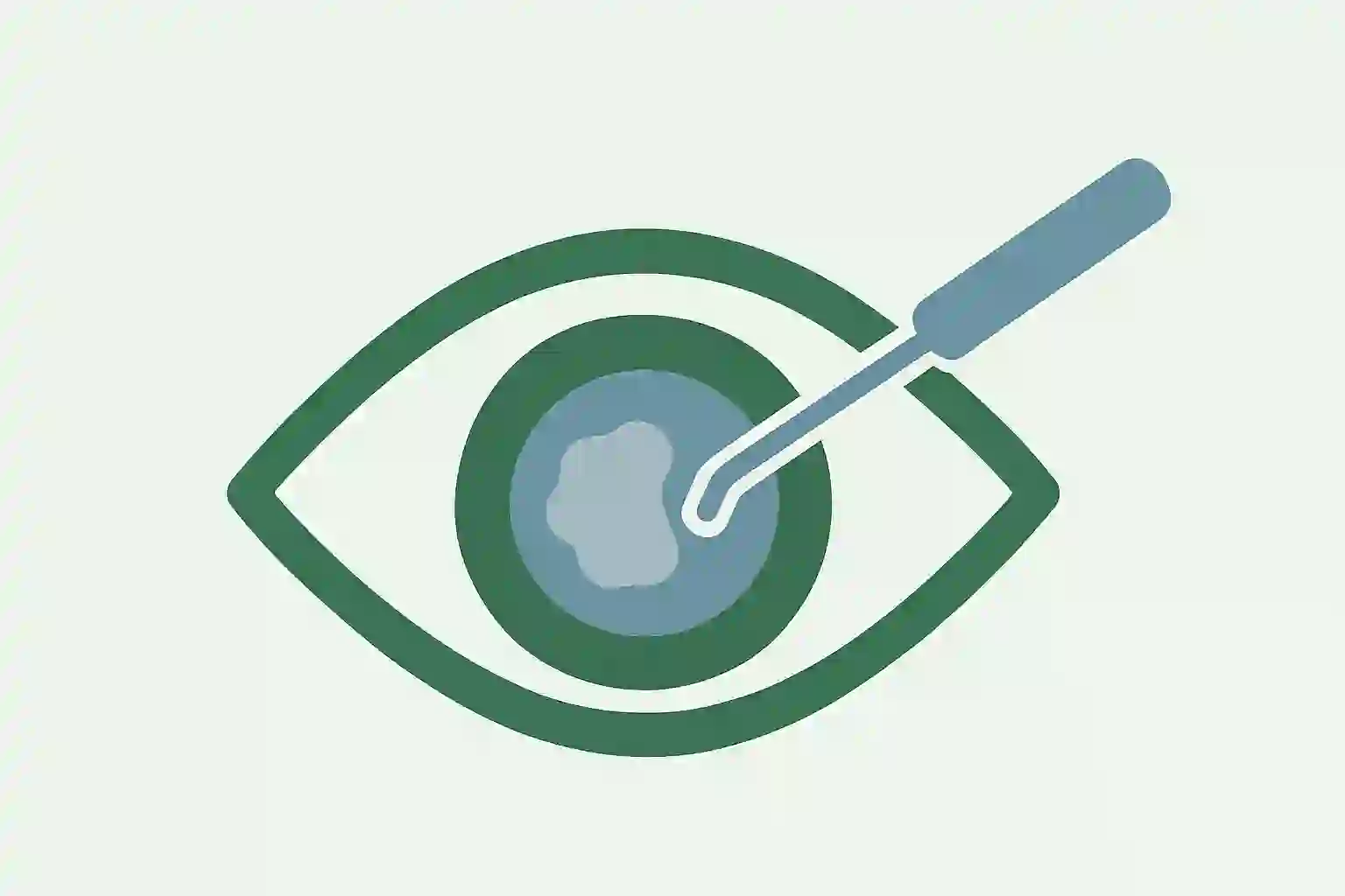 Cataract Surgery - Ophthalmology