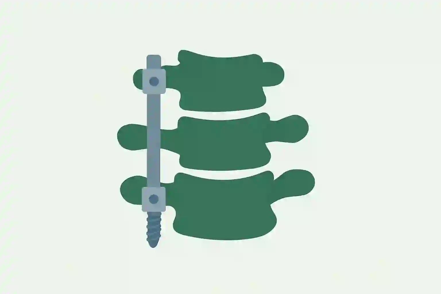 Spine Surgery - Orthopedics